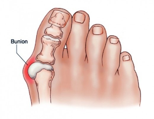 fájdalom kezelése a nagy lábujjak ízületeiben