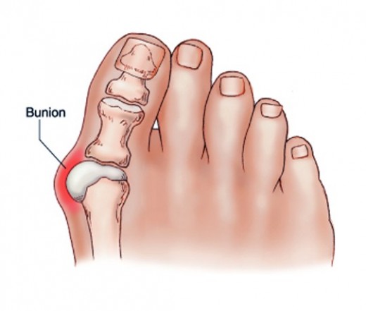 nagy lábujj ízületek fájdalomkezelése a lábfej lábujjízületének ízületi kezelése
